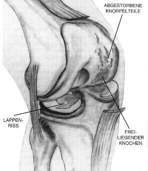 knorpelschäden02