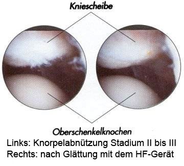 knorpelschäden03