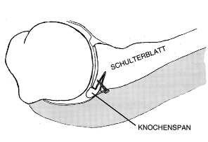 schulter lux 03