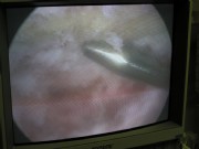 massives Impingement nach der Glättugn