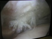 massives Impingement