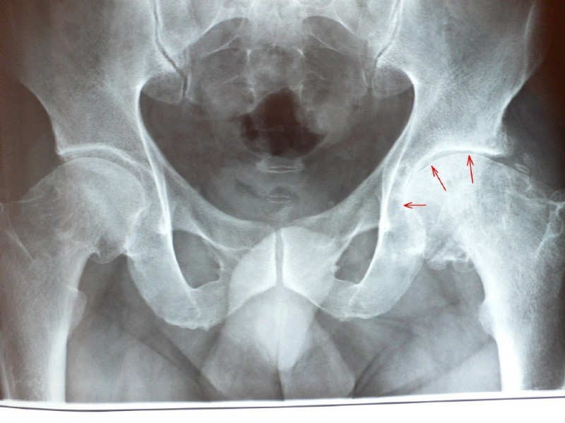 Патология тазобедренного сустава. Коксартроз 3 стадии рентген. Рентген больных суставов. Остеофиты тазобедренного сустава на рентгене фото. Рентген признаки коксартроза 1 степени.