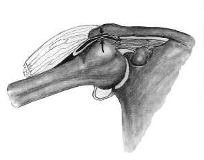 Humeroscapularis artrosis, hogyan kell kezelni