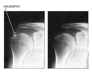 humeroscapularis arthrosis)